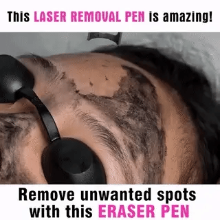 Stylo Laser pour l'Élimination des Tatouages, Moles et Taches de Rousseur