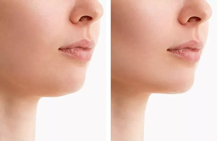 Ceinture de Thérapie par Lumière Rouge pour le Contour du Menton pour Réduire le Double Menton
