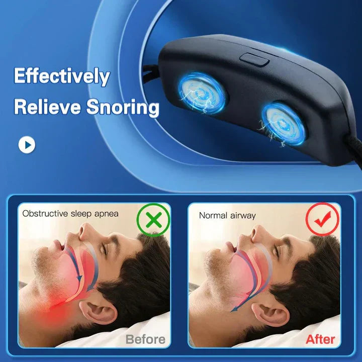Dispositif Anti-Ronflement Intelligent Portable avec Pulsations EMS pour un Sommeil Confortable et un Soulagement de l'Apnée du Sommeil - Rechargeable par USB
